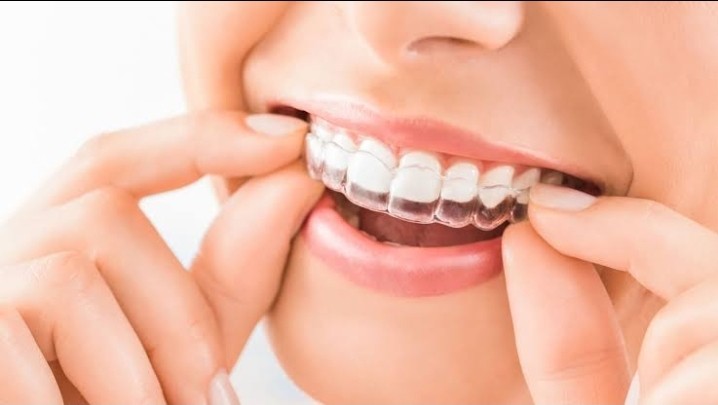Be familiar with the pros of Invisalign